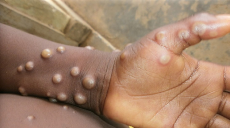 Bayelsa, Lagos, Ogun Lead As Mpox Virus Hits 33 States, FCT With 39 Confirmed Cases