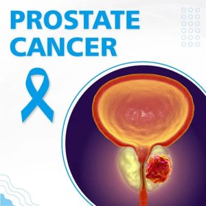 Experts Advocate Annual Screening to Combat Prostate Cancer in Nigeria