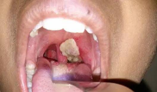 FG Activates Emergency Response as Diphtheria Outbreak Hits Kano, Katsina